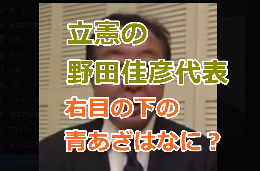 立憲の野田佳彦代表の右目の下が青あざみたいに見えるのは何？病気かただのくま？